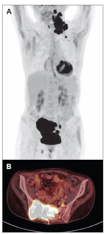 18F-FDG PET/low dose CT. A – snímek PET/low
dose CT krku a trupu; viditelný zvýšený metabolický obrat
v levostranných krčních a mediastinálních uzlinách
a v pravé části pánve. B – fúzovaný obraz PET/low dose
CT, transaxiální řez; zvýšená metabolická aktivita v křížové
kosti vpravo. Zdroj: Oddělení nukleární medicíny,
Proton Therapy centre, s. r. o.