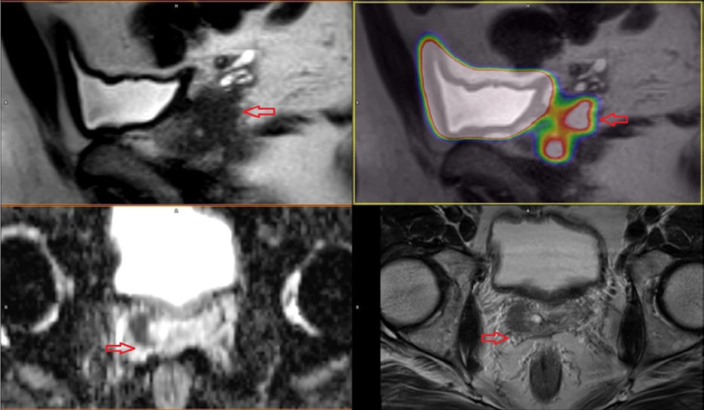Karcinom prostaty v pravém laloku se šířením do semenného váčku cT3b<br>
Fig. 3. Prostate cancer in right lobe with right seminal vesicle invasion 