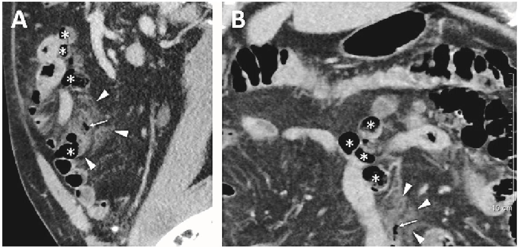 A,B  Vícečetné divertikly jejuna (*) – na jeden z divertiklů navazuje drobný proužek pneumoperitonea (→) se závojováním okolního peritoneálního tuku (◄) jako obraz cirkumskriptní peritonitidy při perforaci