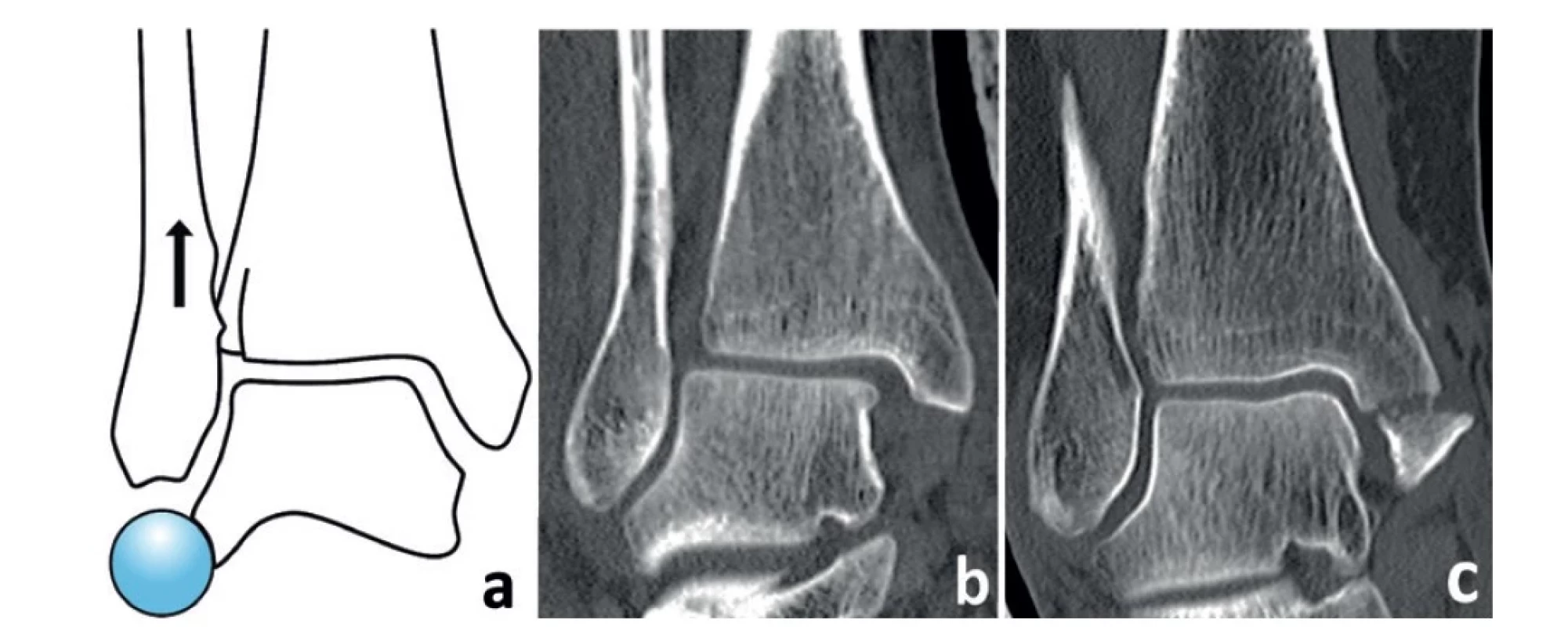 Fibulo-talární vztah (lateral gutter)<br>
(a – tradiční Weberovo schéma demonstrující proximální posun fibuly (šipka), b – nestabilní pronačně-everzní MZ
s laterálním posunem talu, rupturou lig. deltoideum a rozšířením tibio-fibulární vidlice, c – stabilní supinačně-everzní
MZ se zlomeninou colliculus anterior, hluboká porce lig. deltoideum je zřejmě intaktní, talus zůstává v anatomické
pozici vzhledem k distální tibii. U obou zlomenin je zachován normální fibulo-talární vztah.)<br>
Fig. 3: Fibulo-talar relationship (lateral gutter)<br>
(a – traditional Weber scheme demonstrating the proximal shift of the fibula (arrow), b – an unstable pronation-
-eversion Maisonneuve fracture with lateral shift of the talus, rupture or the deltoid ligament and widening of the
tibiofibular mortise, c – a stable supination-eversion MF with a fracture of the anterior colliculus; the deep portion
of the deltoid ligament is obviously intact, the talus remains in the anatomical position in relation to the distal tibia.
Both fractures show a preserved normal fibula-talar relationship.)