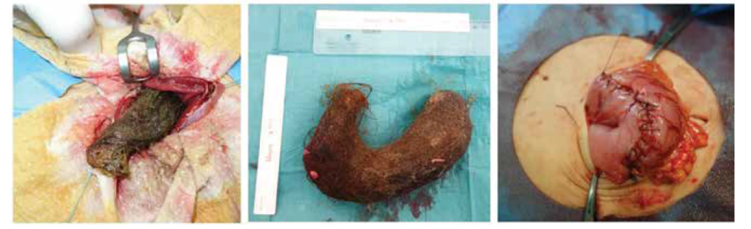 Peroperační nález při gastrotomii, sutura žaludku.<br>
Fig. 3. Intraoperative finding in gastrotomy; gastric suture.