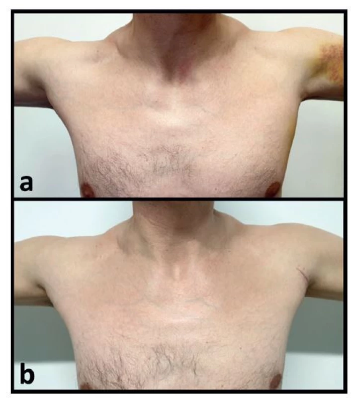 Pacient s akutní kompletní izolovanou rupturou
pars sternocostalis m. pectoralis major vlevo<br>
Fig. 6: Patient with acute complete isolated rupture of the
sternocostal part of the pectoralis major on the left side