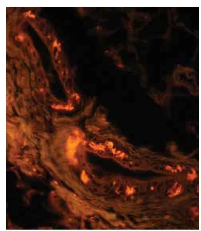 AL amyloidóza – fluorescenční mikroskopie<br>
Drobná depozita ve stěně krevních cév s červenou
fluorescencí. Původní zvětšení 600krát.