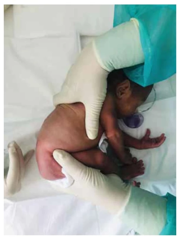 Poloha novorodenca v ľahu na boku (lateral decubitus
position) počas LP (archív Neonatologickej kliniky JLF UK
a UNM)