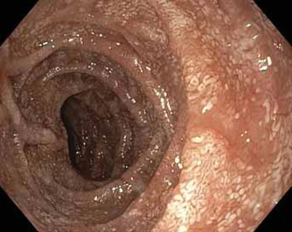 Postbulbární část duodena – vstupní endoskopické vyšetření.<br>
Postbulbar part of duodenum – initial endoscopic examination.