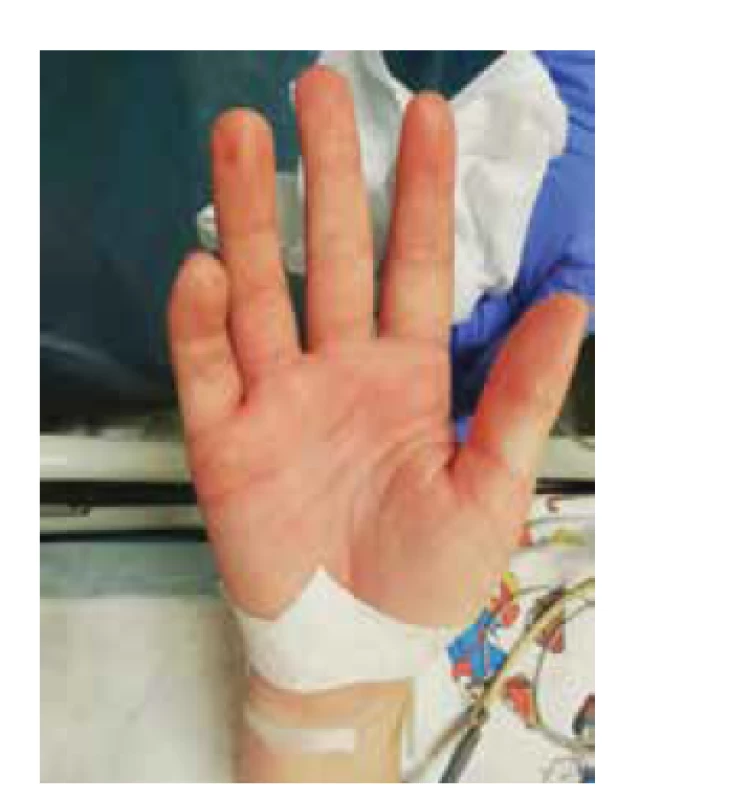 Palmárny erytém pacientky z klinického prípadu 2.<br>
Fig. 2. Palmar erythema of the patient from case report 2.