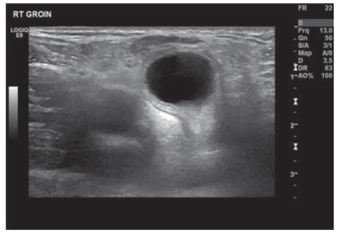 Ultrazvuk pravé kyčle zobrazující cystu<br>
Fig. 2: US right groin showing cyst