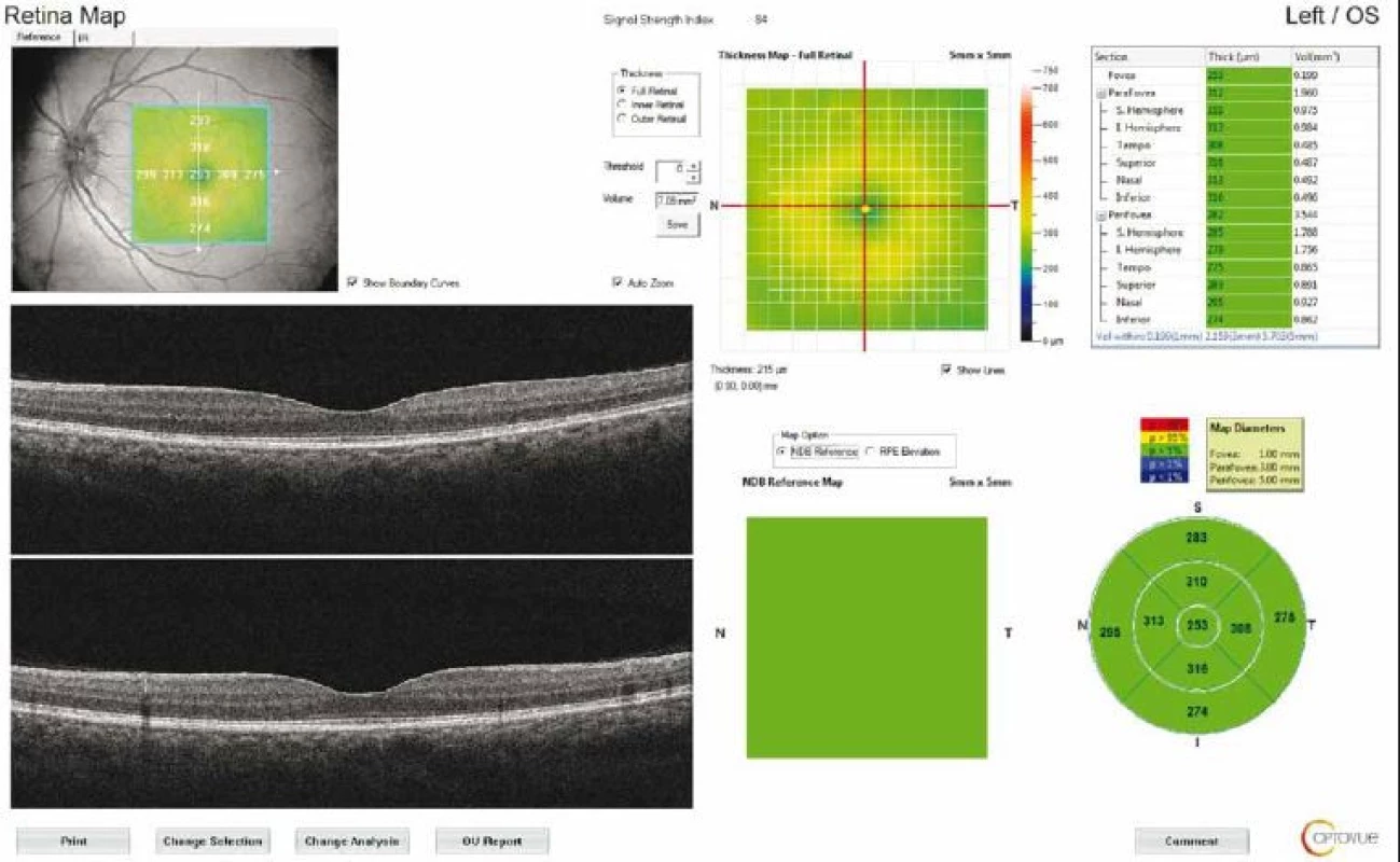 Retinal map output of a patient with idiopathic intracranial hypertension. The average thickness of the nine regions and topographic
map of retinal thickness are shown on the diagrams. Fovea thickness (central 1 mm) was noted.<br>
Obr. 2. Výsledek mapování sítnice u pacienta s idiopatickou intrakraniální hypertenzí. V grafu je znázorněna průměrná tloušťka devíti
oblastí a topografická mapa tloušťky sítnice. Byla zaznamenána tloušťka fovey (centrálně 1 mm).