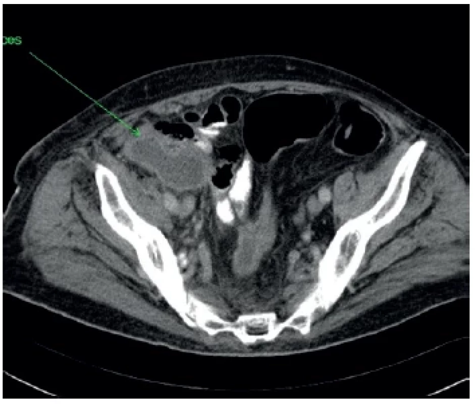 Pokračovanie abscesovej dutiny v úrovni panvových
kostí <br> 
Fig. 3. Continuation of the abscess cavity at the level of
the pelvic bones