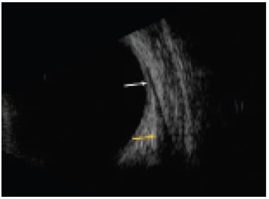 B-scan of rectus muscle in longitudinal view, in the upper
part of the echogram the insertion of the muscle is visible (white
arrow), in the lower part the muscle belly (yellow arrow)