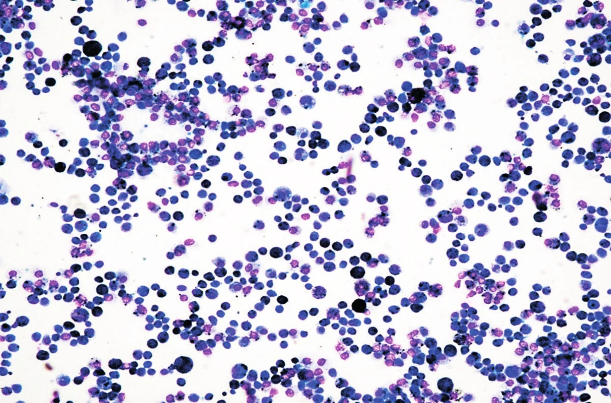 Cytologické vyšetrenie materiálu z bronchoalveolárnej
laváže. Farbenie podľa Giemsa.<br>
Fig. 2. Cytological examination of material from bronchoalveolar
lavage. Coloring by Giems.