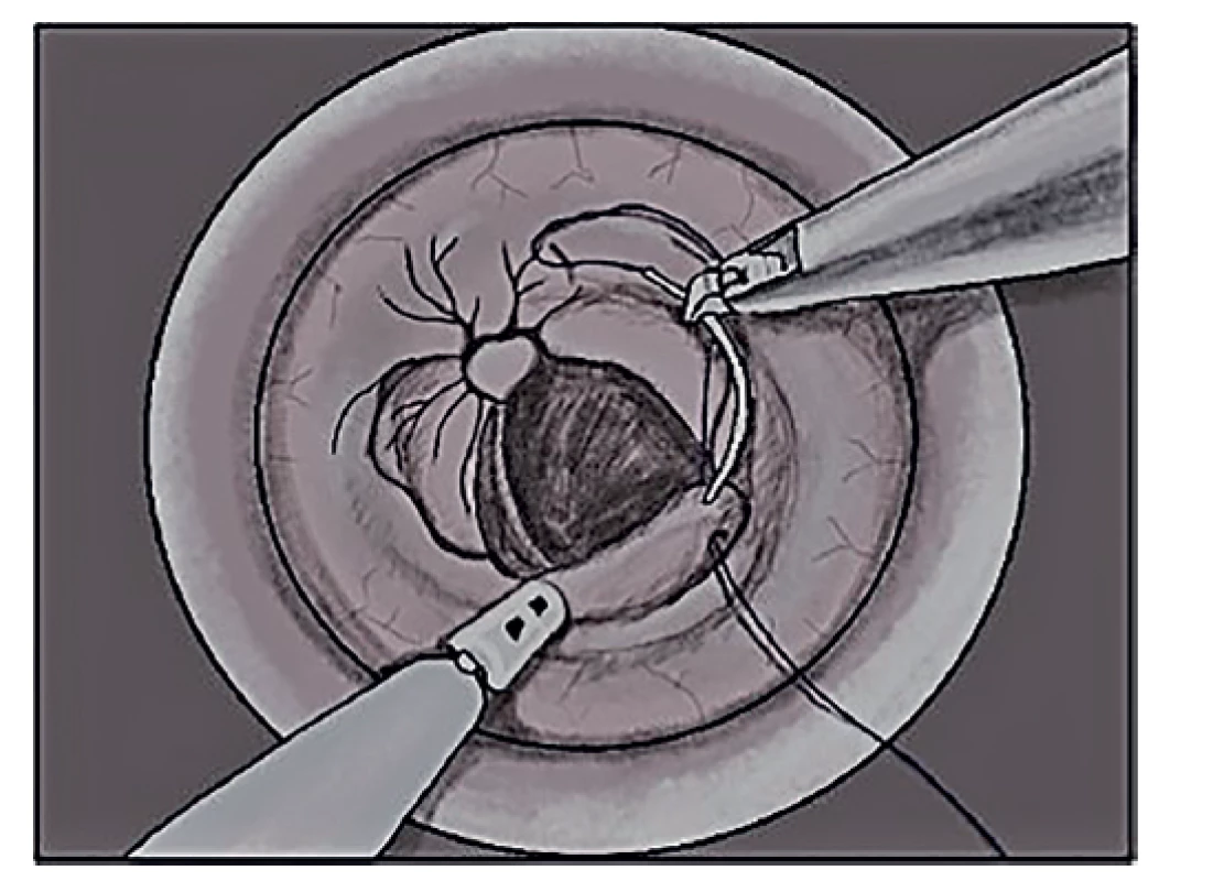 Naložení cirkulárního stehu aborálně od nádoru<br>
Fig. 3: Circular suture below the distal margin of the
tumour