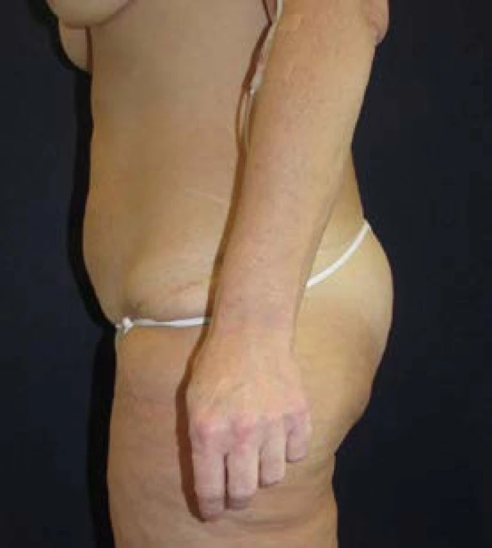 Lower body lifting – boční pohled pooperačně