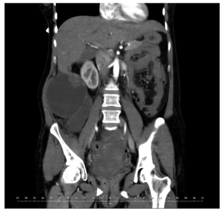 CT břicha, koronární řez <br>
Bilokulární expanze v pravém retroperitoneu v intimním vztahu k pravé ledvině.  <br>
Fig. 1: Abdominal CT, coronary view <br>
Bilocular expansion in the right retroperitoneum in close relationship with the right kidney.