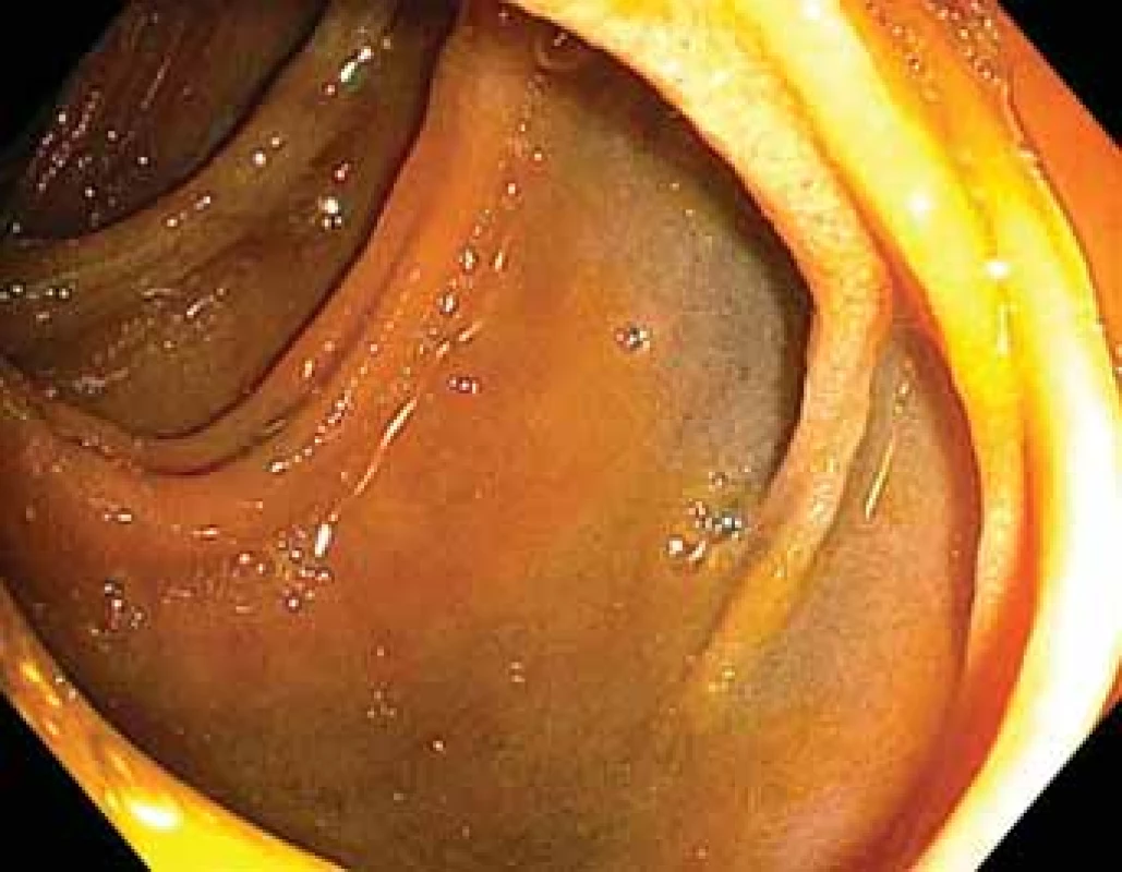 Totální enteroskopie – dosažení tetováže aplikované při předchozí orální enteroskopii.<br>
Fig. 3. Total enteroscopy – reaching tattoo applied during
previous enteroscopy from an oral approach.