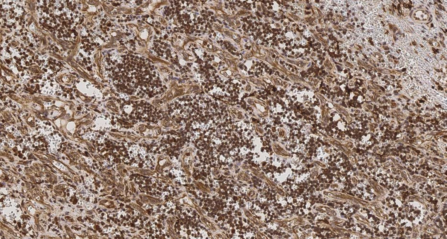 Pozitivita makrofágů červené pulpy sleziny: zvětšeno 200x, IHC CD68 pozitivní<br>
Fig. 5. Positive macrophages of the red pulp of the spleen: 200x magnification, IHC CD 68 positive