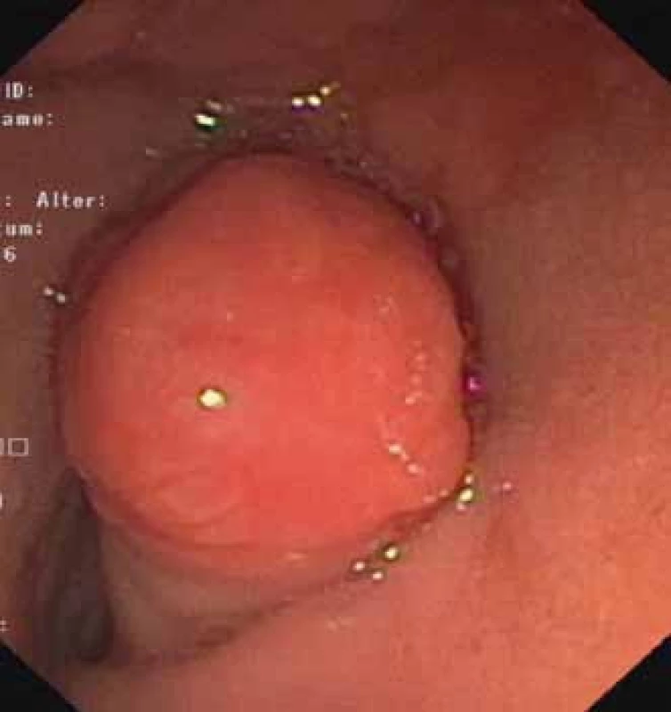 Polyp prolabujúci z D2 do bulbu duodéna.<br> Fig. 1. A polyp prolapsing in the duodenal bulb.