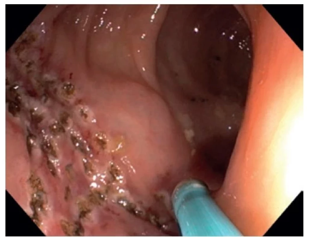 Endoskopický obraz – stav po ošetření krvácejících
lézí lokálně argon plazma koagulací<br>
Fig. 2: Endoscopic image – after local treatment of the
bleeding lesions with argon plasma coagulation