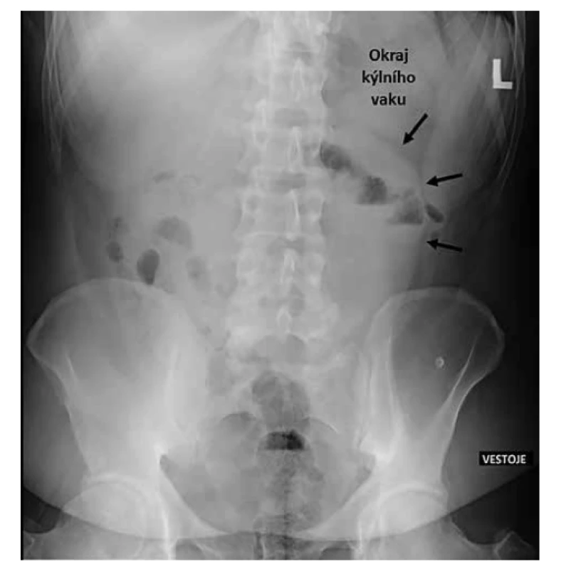 RTG snímek břicha<br>
Fig. 2: Abdominal X-ray