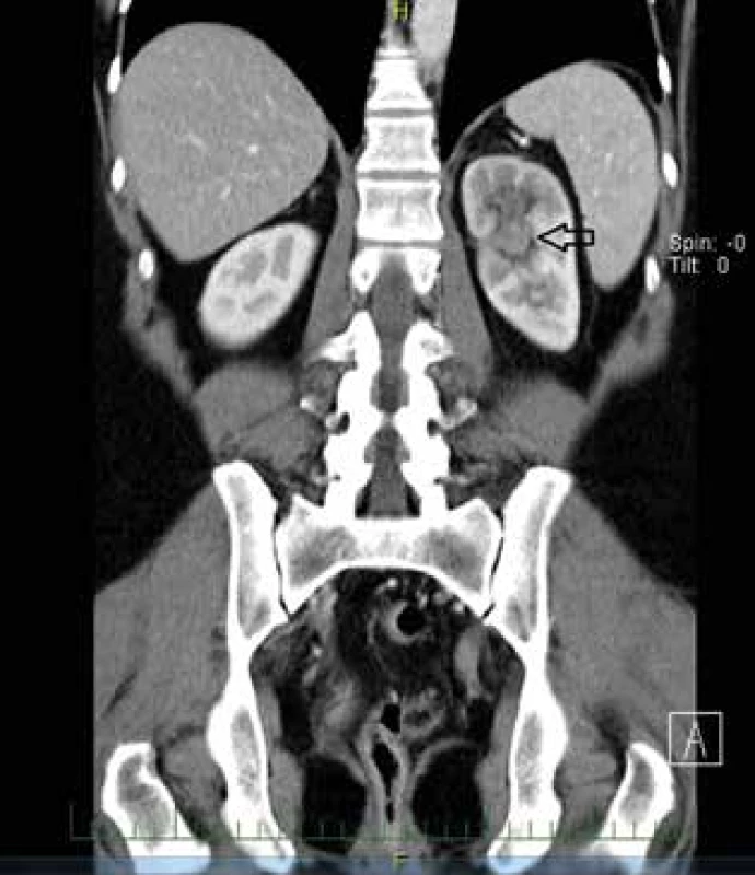 Pokročilý uroteliální karcinom pánvičky levé ledviny – CT <br>
Fig. 8: Advanced urothelial carcinoma of the renal pelvis
of the left kidney − CT