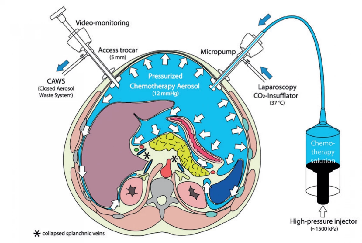 Princip PIPAC [9]<br>
Fig. 1: Principle of PIPAC [9]