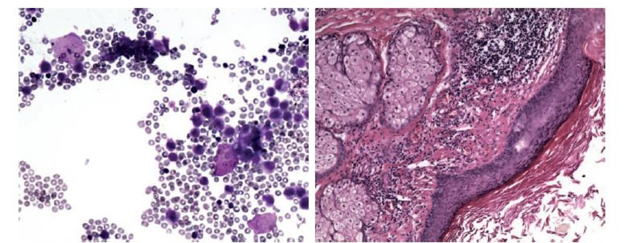 Koetánní teratom – korelace cytologického a histologického obrazu. V cytologickém obraze směs zánětlivých buněk, dermálních elementů,
dlaždicových epitelií a bezjaderných skvam. MGG, 200x. V histologickém obraze struktury dermoidní cysty. HE, 200x.