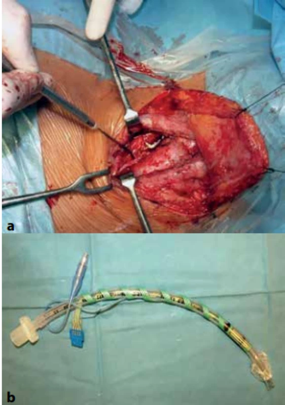 Peroperačný neuromonitoring <br>
a: verifikácia signálu NLR sondou, b: snímacia elektróda nalepená na intubačnej kanyle<br>
Fig. 1: Perioperative neuromonitoring 
a: verification of the signal by the NLR probe; b: sensing electrode is attached to the intubation cannula