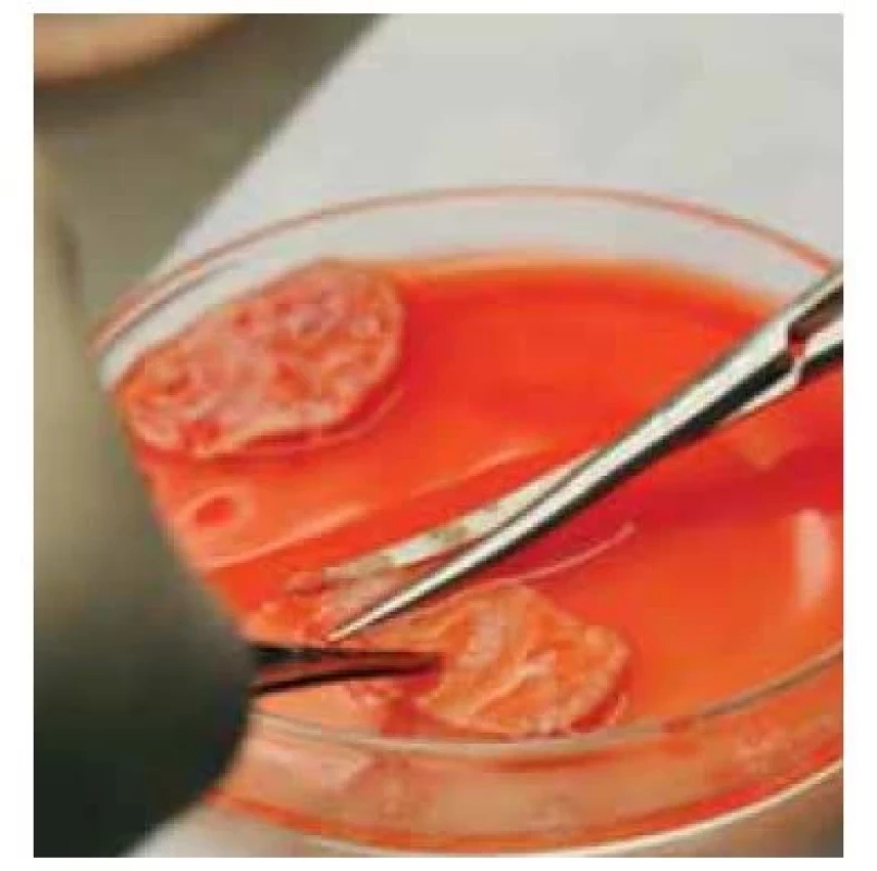 Odstraňování medulární části
z ovaria.<br>
Fig. 5. Removal of the medullary portion
from the ovary.