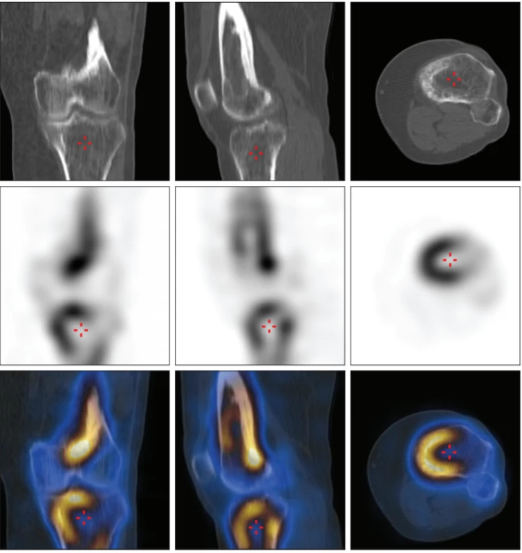 SPECT/CT kolen vč. fúze, zobrazeny řezy levým kolenem s patologickým zvýšením akumulace radiofarmaka v distální partii femuru
a v proximální části tibie (horní řada LDCT, střední řada SPECT, dolní řada fúze obrazů; levý sloupec řezy ve frontální rovině, střední sloupec
v sagitální rovině a pravý sloupec v transverzální rovině). 
