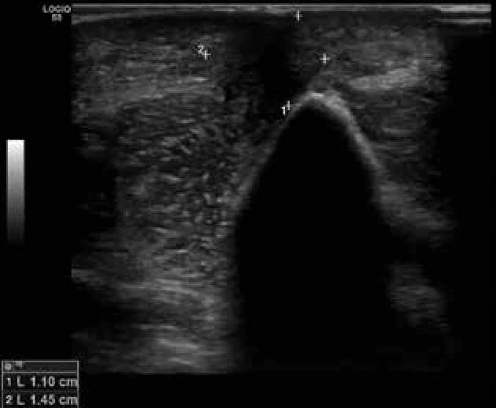  Sonografický nález fibrózního uzlu v podkoží pravého
loktu před léčbou antibiotiky 