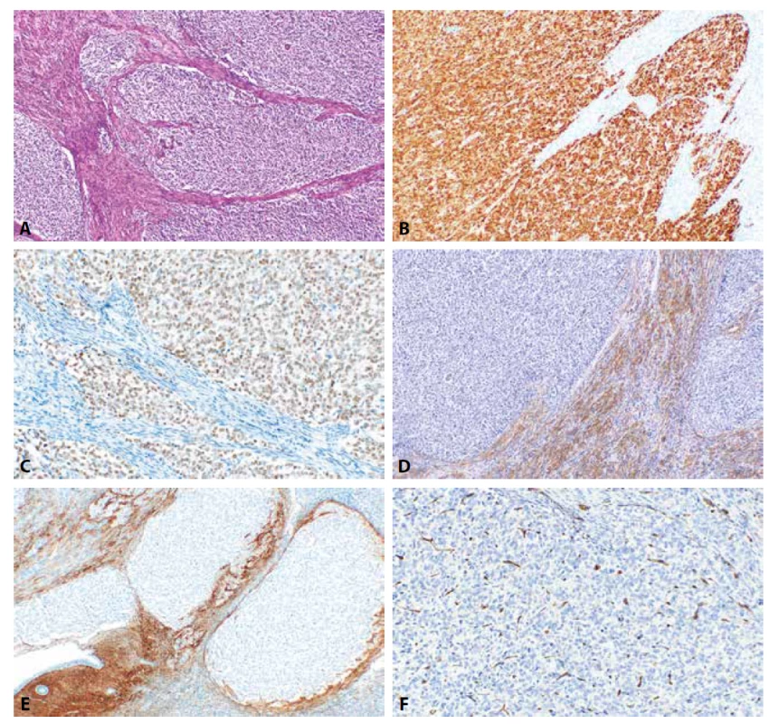 High grade endometriální stromální sarkom s prokázanou fúzí YWHAE-NUTM1A. Nádorové struktury infiltrující myometrium (4A,
HE, 100x). Nádorové buňky vykazují silně intenzivní jadernou pozitivitu cyklinu D1 (4B, 100x) a jadernou pozitivitu při průkazu BCOR (4C, 200x).
Negativní je v nádorových strukturách α-hladkosvalový aktin (4D, 100x), CD10 (4E, 100x) a IFITM1 (4F, 200x).