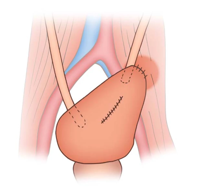 Schéma „psoas hitch“ – vytažení
a fixace měchýře na m. psoas
za účelem zkrácení vzdálenosti mezi
měchýřem a pahýlem močovodu
k provedení anastomózy (zdroj: Filip
Mareš, licence CC-BY 4.0)<br>
Fig. 4. Psoas hitch diagram – the
bladder is pulled up and secured
to the psoas muscle, to reduce the
distance between the distal ureter
and the bladder so an anastomosis
can be performed