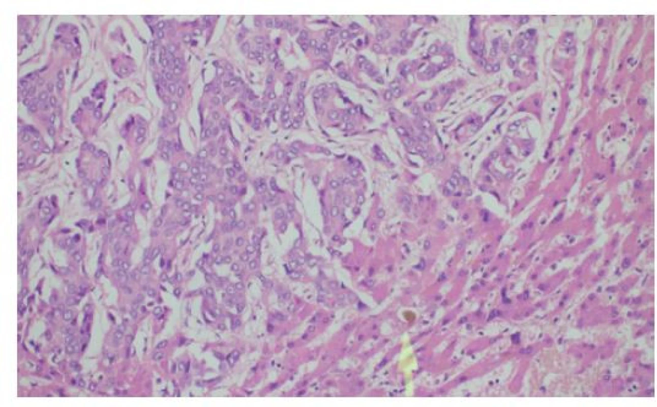 Histologie cholangiocelulárního adenokarcinomu
jater solidně-trabekulární stavby s anastomozujícími
trámci nádorových buněk, fokálně s rudimentárními žlázovými
luminy<br>
Šipka označuje žlučový trombus při akutní cholestáze v přilehlém
nenádorovém parenchymu jater, HE, 200×<br>
Fig. 4: Histology of liver cholangiocellular adenocarcinoma
characterized by solid trabecular-anastomosing
arrangement with occasional glandular lumina<br>
The arrow shows bile accumulation in adjacent liver parenchyma
due to acute cholestasis, HE, 200×
