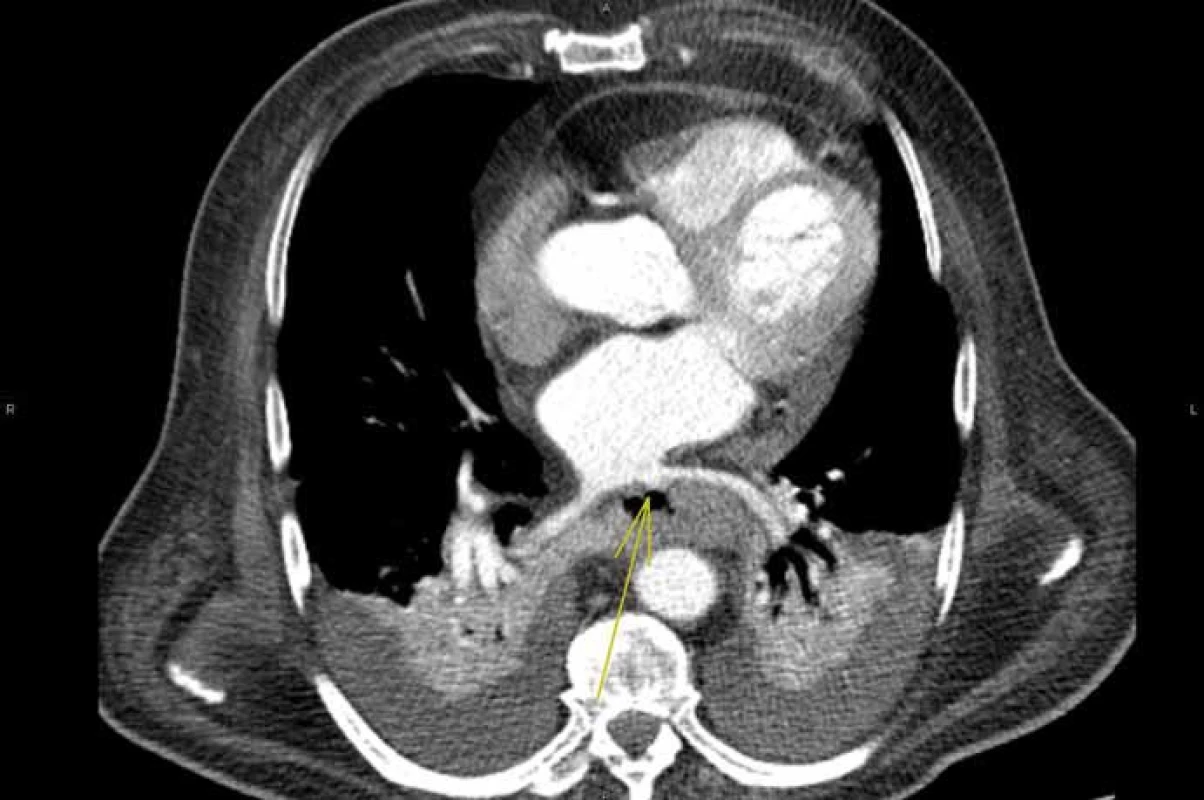 Píštěl naplněná kontrastní látkou z lévé síně.<br> Fig. 5. Fistula filled with contrast agent from the left atrium.