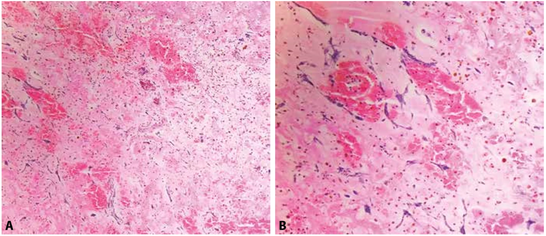 A: Srdeční myxom s regresivními změnami (hemoragie, depozita hemosiderinu, fibrinoidní prosáknutí) a okrsky extramedulární hematopoézy (hematoxylin & eosin, 100x). B: Detail na hvězdicovité myxomové buňky (hematoxylin & eosin, 200x).