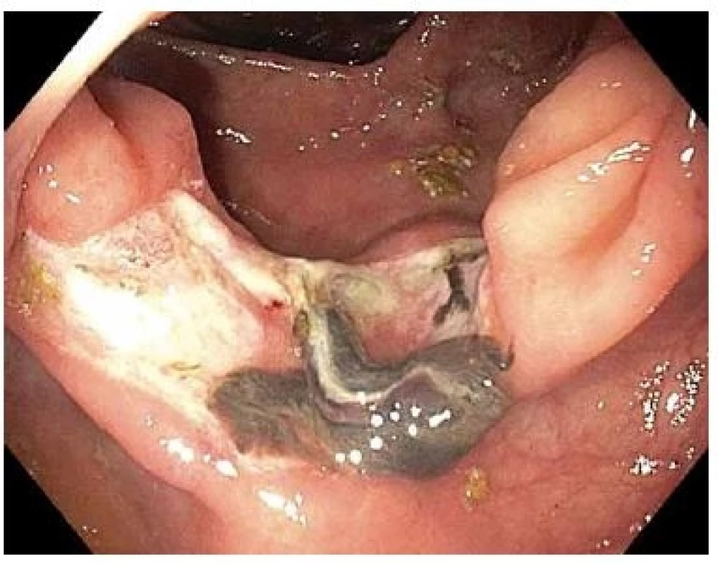 Spodina po FTR s již nepřítomným OTS klipem přisedlým koagulem u pacienta hospitalizovaného pro hematochézii 14. den po FTR.<br> Fig. 6. Base after FTR with adhered coagulum in patient readmitted for haematochesia on the 14<sup>th</sup> day after FTR.