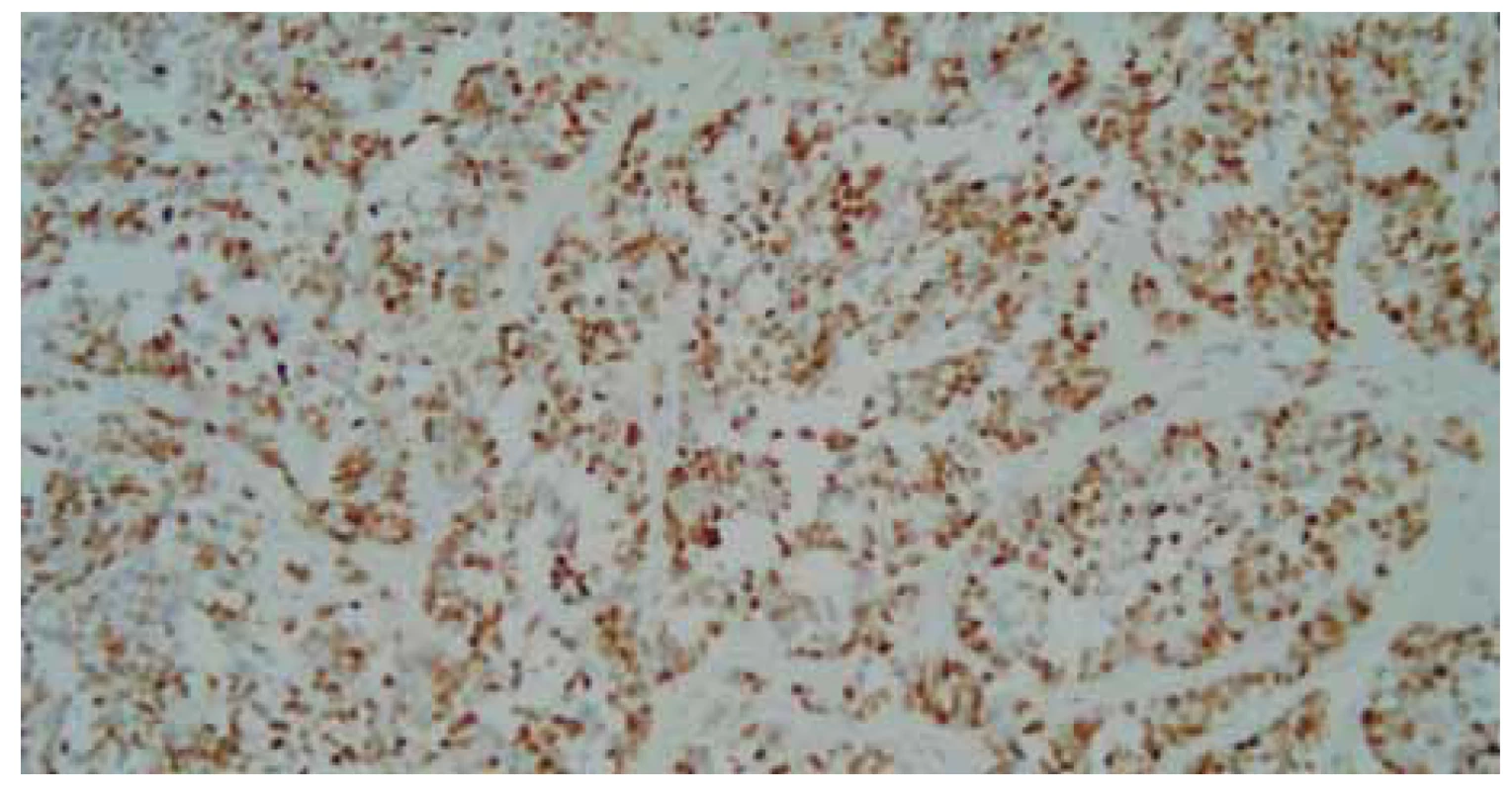 Detailnejší pohľad na malobunkovú nádorovú proliferáciu, farbenie hematoxylin-
eozinom, zväčšenie 200×.<br>
Fig. 8. A more detailed view of small cell tumour proliferation, hematoxylin eosin
staining, magnifi cation 200×.
