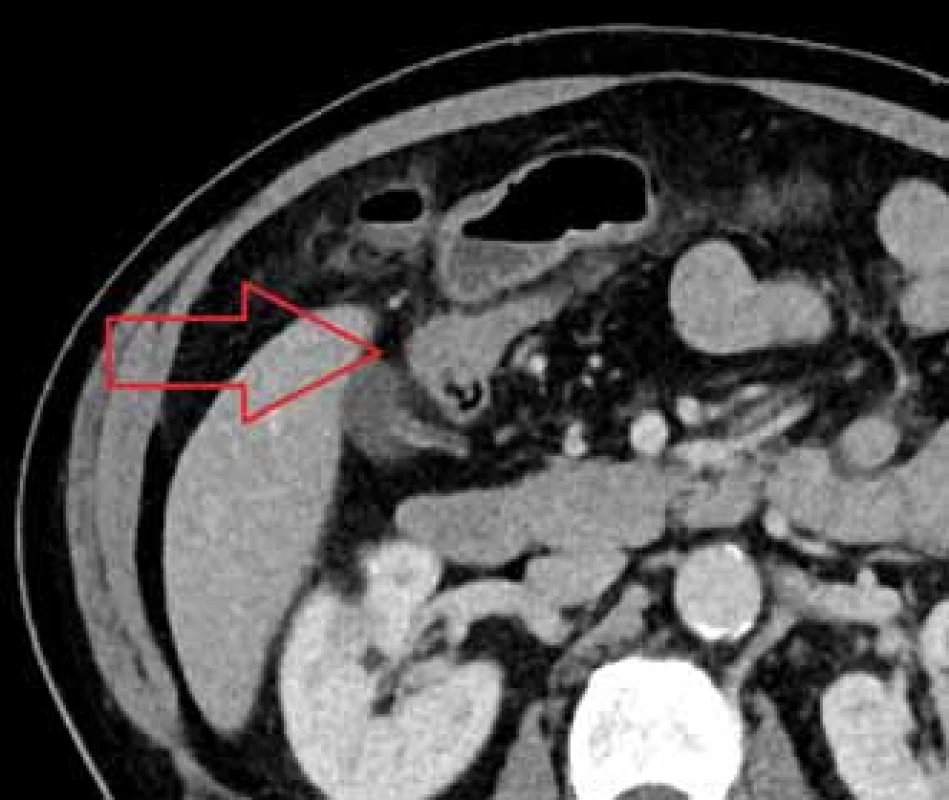CT nález slepé výchlipky tenkého
střeva na antimesenteriální
straně v podjaterní krajině s prosáknutím
okolní tukové tkáně, později provedena
resekce Meckelova divertiklu.
Fig. 2. CT finding of a blind pouch of
small intestine on the antimesenteric
side with infiltration of fatty tissue;
Meckel‘s diverticulum was later
resected.