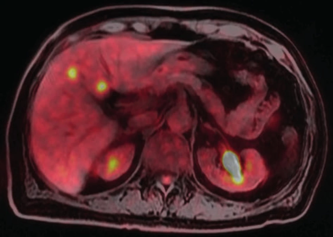 PET-MR obraz metastáz v segmentu S4<br>
Fig. 2: PET-MR scan with two metastases in S4 segment