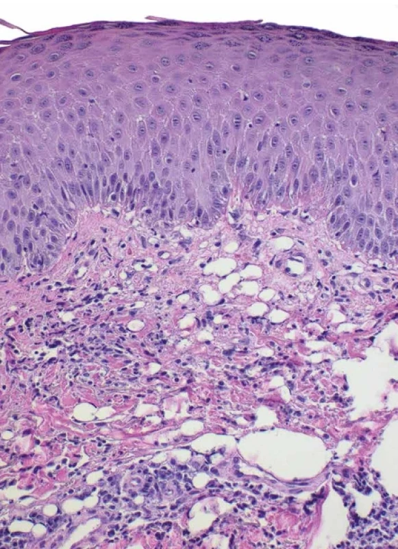  Pseudolipomatosis cutis u acrodermatitis chronica atrophicans (HE, 
původní zvětšení 200x).