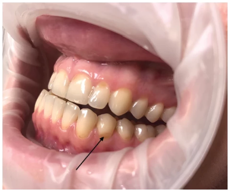 Zubní eroze (označené
černou šipkou) <br> 
Fig. 4
Dental erosion (black arrow)