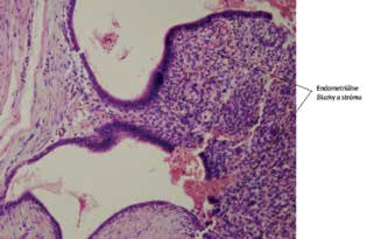 Endometrióza v  jazve: detailne zobrazené endometriálne žliazky. Farbenie Hematoxylín-eozín 100×<br>
Fig. 7: Abdominal wall endometriosis: detailed view of 
the endometrial glands, HE 100×
