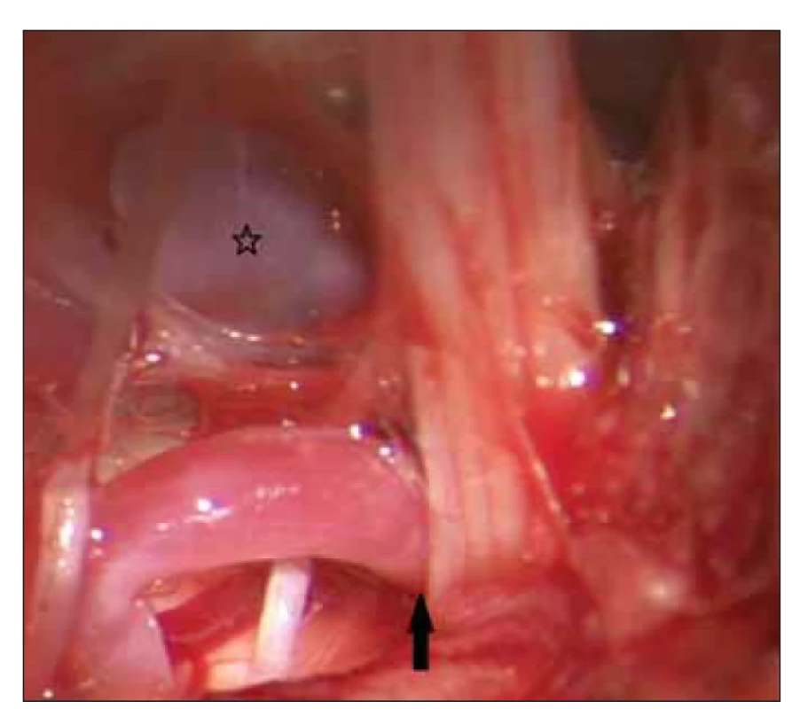 Neurovaskulární konflikt mezi arteria cerebelli posterior
inferior a komplexem IX.–XI. nervu (šipka). Arteria vertebralis
označena hvězdičkou.<br>
Fig. 1. Neurovascular conflict between posterior inferior cerebellar
artery and n. IX–XI complex (arrow). Vertebral artery marked
by star.