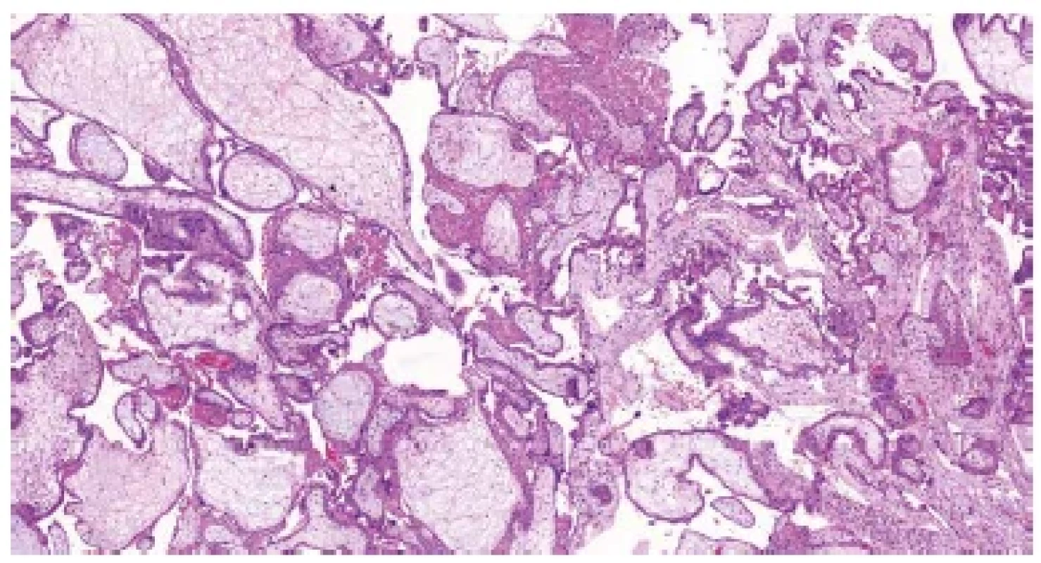 Trizomie chromozomu 21. Nepravidelné choriové klky s mírným edémem
stromatu, trofoblastickými inkluzemi a fokální hyperplázií trofoblastu
(HE, 50x).