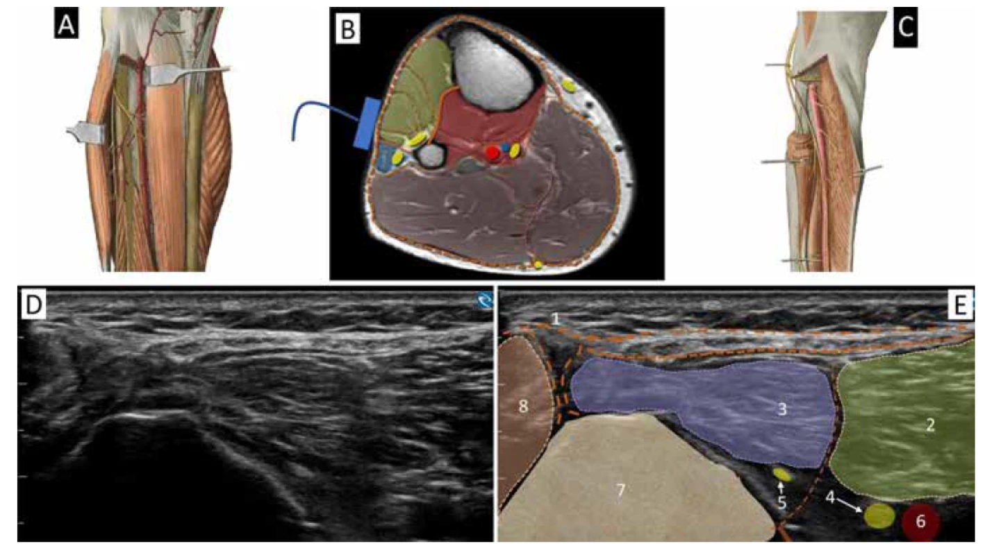 Průběh n. peroneus profundus a superficialis pod hlavičkou fibuly. A. anatomický pohled do předního a laterálního kompartmentu. B. schéma
kompartmentů bérce a poloha UZ sondy pro obr. D a E. C. pohled na proximální průběh n. peroneus profundus a superficialis po částečném odstranění
mm. peronei a dlouhých extensorů nohy, zachován m. tibialis anterior. D. ultrazvukový obraz proximální části bérce nad fibulou. E. kolorovaný obraz
D: 1. hluboká fascie, 2. extensor digitorum longus, 3. m. peroneus longus, 4. n. peroneus profundus, 5. n. peroneus superficialis, 6. arteria tibialis anterior,
7. fibula. 8. m. gastrocnemius lateralis