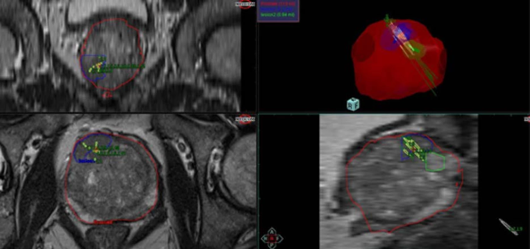 Report po softwarové fúzní biopsii prostaty<br>
Fig. 3. Report after software fusion – guided prostate biopsy