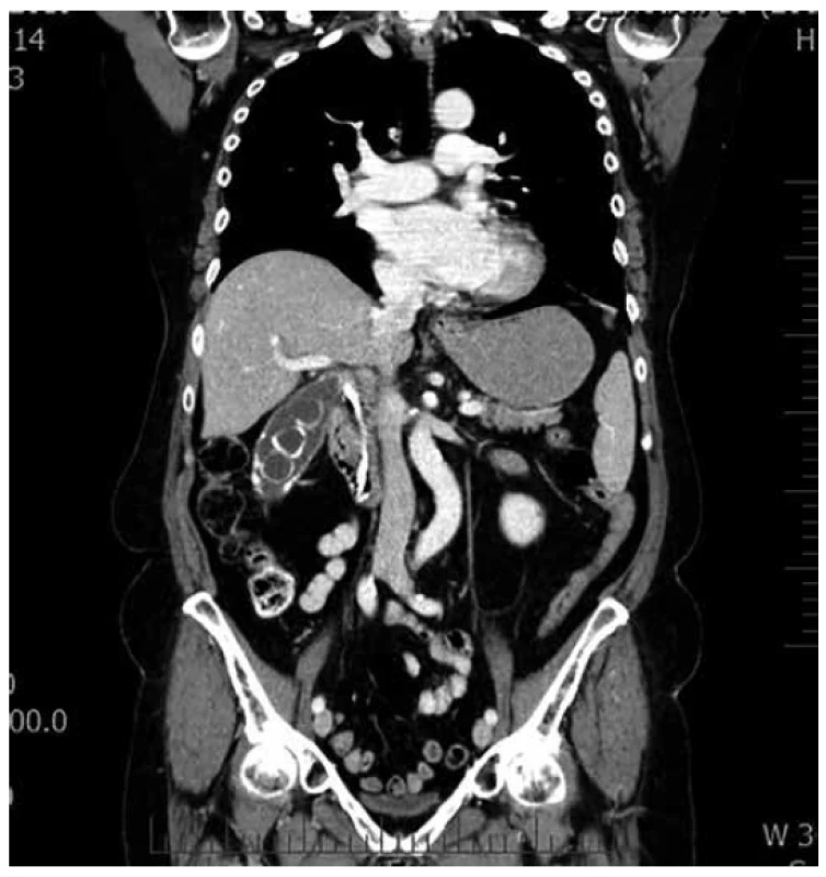 CT břicha<br>
Fig. 2. CT of the abdomen