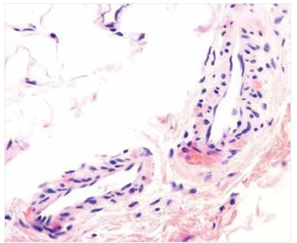 AL amyloidóza – histopatologie<br>
Drobná depozita ve stěně krevních cév pozitivní v reakcích
s konžskou červení. Původní zvětšení 600krát.