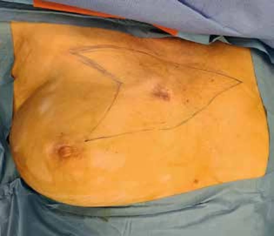 Stav před operací <br>
Fig. 3: Preoperative findings