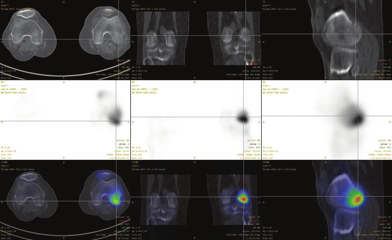 Fúze SPECT/CT obrazu u pacienta s disekující osteochondritidou v méně časté lokalizaci v inferocentrální části laterálního kondylu
femuru v časném stádiu I. V horní řadě je obraz z LDCT postupně v transaxiální, koronární a sagitální rovině. Střední řada ukazuje odpovídající
SPECT řezy. Dolní řada prezentuje odpovídající fúzované SPECT/CT řezy. Scintigrafický nález je v časném stádiu výrazný, nález na
LDCT normální.